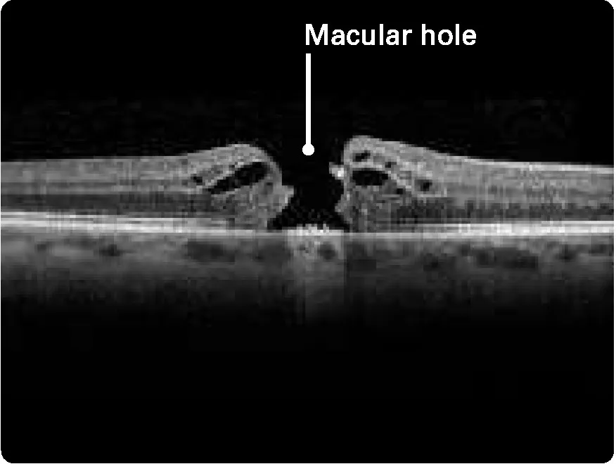 A similar X-ray to the previous, but in place of the dip is a complete break in the outer layer, labeled “Macular hole”.