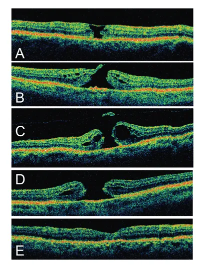 Five images, labeled A through E, of various types of macular holes. Some pull up and away from the lower layer of material, some have a thin amount of material stretching the hole, and the bottom image, labeled “E”, has a very slightly curved dip where the hole is in the other images.