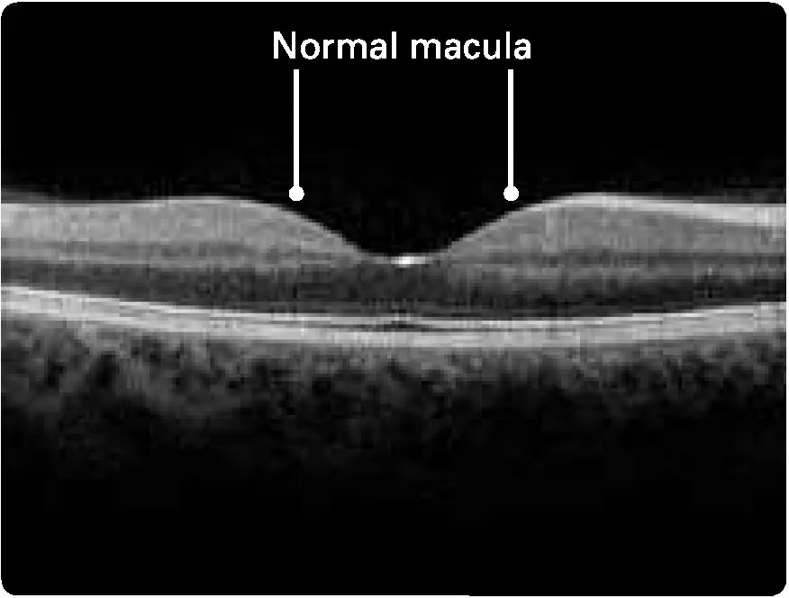 A close-up X-ray of a retina, side on. There is a subtle curve downward on the outer layer of material, which never fully breaks. This is labeled “Normal macula”.